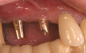 Implants in pace side of mouth