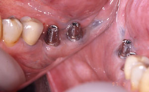Closeup of dental implants in place