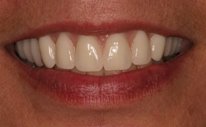 Closeup of flawless smile with cosmetic dentures