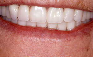 Closeup of healthy smile with cosmetic dentures