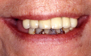 Closeup of damaged teeth before dentures