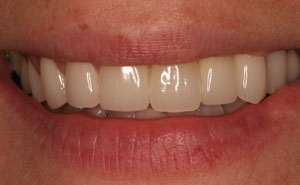 Flawless smile after