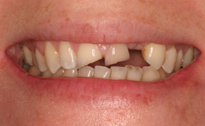 Broken damaged teeth before makeover