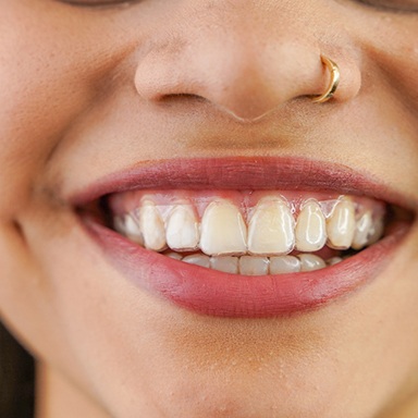 young woman wearing Invisalign tray 