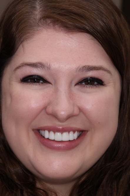 Jackie showing teeth after smile transformation