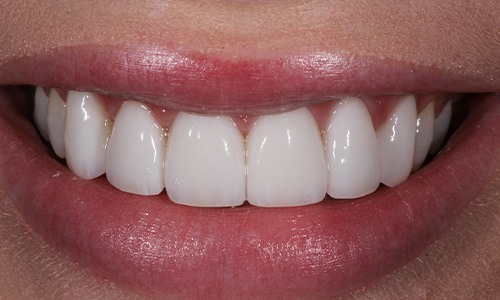 Close-up of teeth with veneers covering discoloration