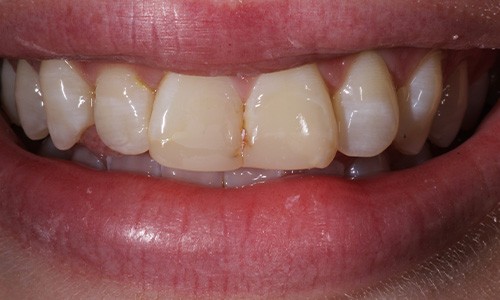 Close-up of teeth with discolored areas