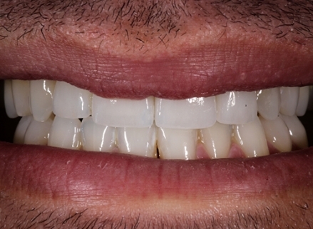Smile of the Month January 2025 after treatment