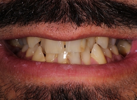 Smile of the Month January 2025 before treatment