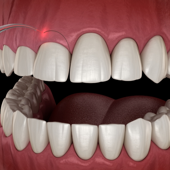 Illustration of a dental laser treating a gummy smile
