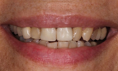 Closeup of Linda  before Long Island veneers