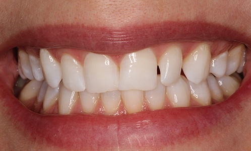 Close-up of smile with misshapen tooth on right
