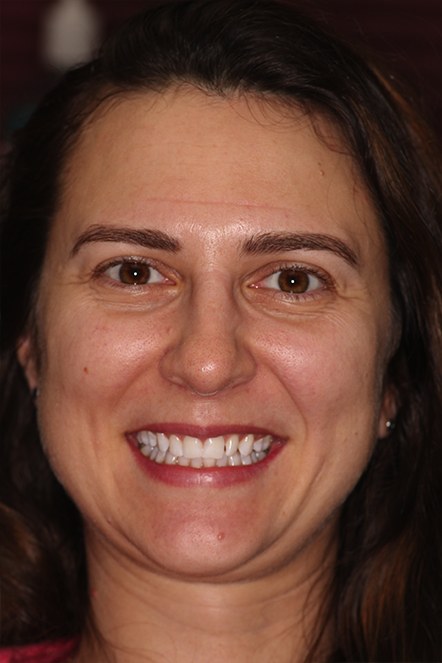 Headshot of Liya before smile makeover