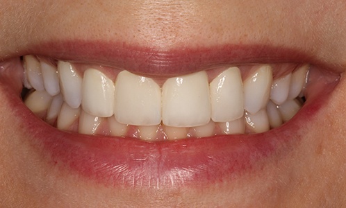 Close-up of smile with misshapen tooth covered by veneer
