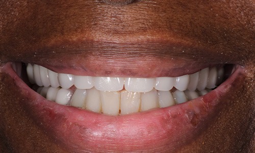 dentures seaford