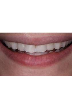 May Dental implant smile of the month patient