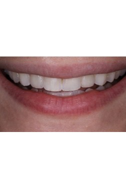 April 2023 Dental implant smile of the month patient