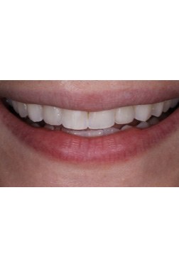 Closeup of Lopez  after Long Island veneers