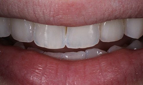Close-up of smile covered by a veneer