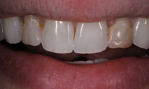 Close-up of smile with single discolored tooth