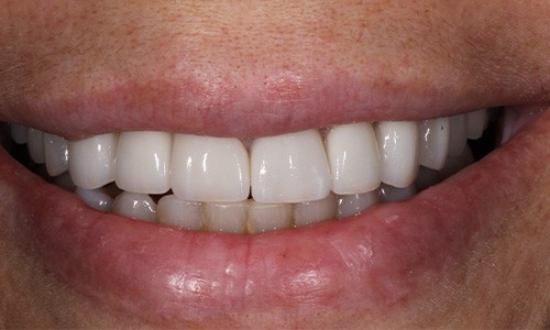 Close up of smile with whiter teeth and gaps closed