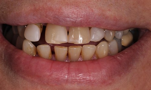 Close up of smile with discoloration and large gaps