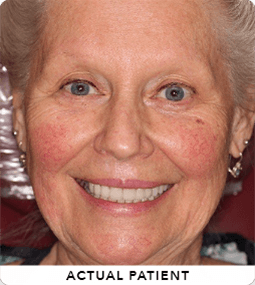 smiling older woman - actual patient