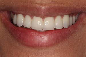 Closeup woman's smile after porcelain veneers