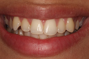 Closeup woman's smile before porcelain veneers