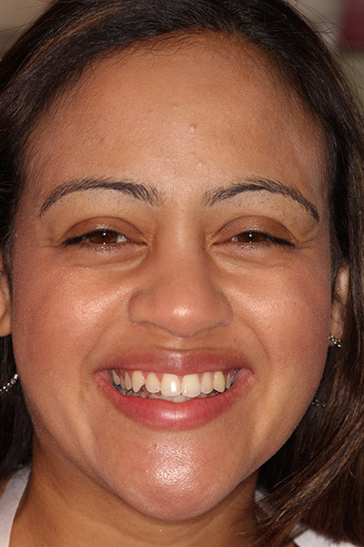 Woman smiling before porcelain veneers