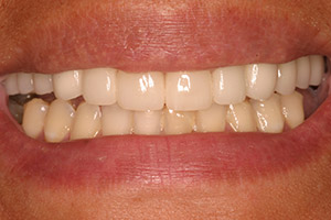 Closeup of brilliant smile after treatment