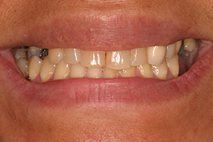 Closeup yellow damaged teeth before treatment