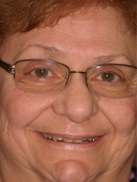 Older female patient before smile makeover
