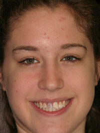 Young woman before smile makeover