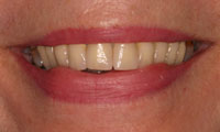 Older woman smile makeover closeup before