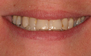 Yellow teeth before makeover