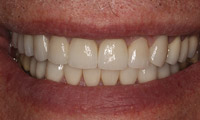 Smile makeover patient closeup front after treatment