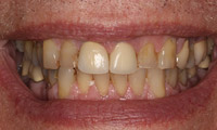 Smile makeover patient closeup front before treatment