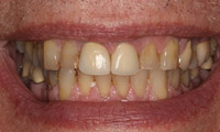 Closeup senior man's smile before treatment