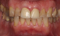 Older man before crown teeth and gums closeup