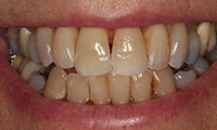 Closeup of front of smile of full makeover patient before