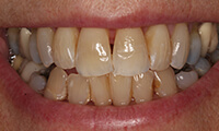 Closeup of front of smile of full makeover patient before