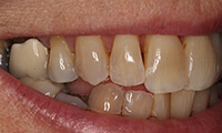 Closeup of side of smile of full makeover patient before