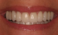 Closeup female smile makeover patient after