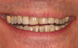 Damaged smile closeup before smile makeover