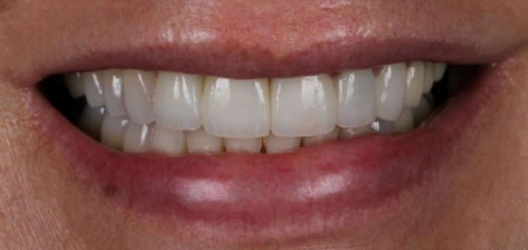 Smile with whiter teeth