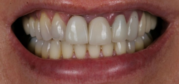 Smile with slightly discolored teeth