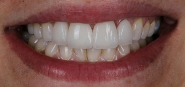 Smile with newly restored two front teeth