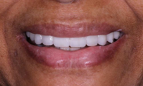 Closeup of Michelle after Long Island veneers