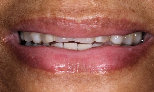 Closeup of Michelle before Long Island veneers